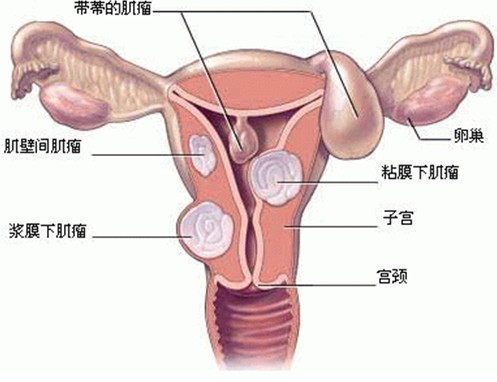 子宫肌瘤示意图