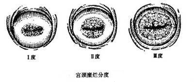 宫颈糜烂三种病变