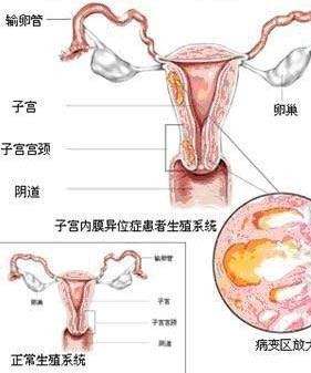 子宫内膜异位症示意图