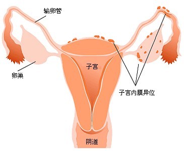 子宫内膜异位症