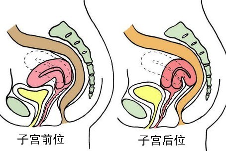 子宫前后位对比图